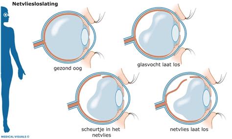 vlekken en flitsen oog.